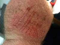 IMG_3487GTBiteBackOfHand.jpg