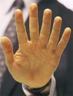 Central Polydactyly - clinical image.jpg