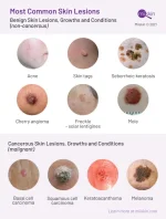 types-skin-lesions-growths-conditions-700x920.webp