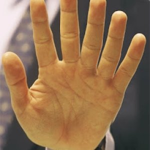 Central Polydactyly - clinical image.jpg